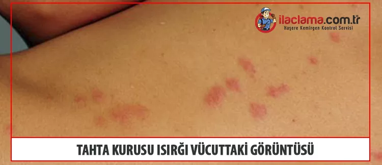 tahta kurusu ısırığının insan vücudundaki görüntüsü