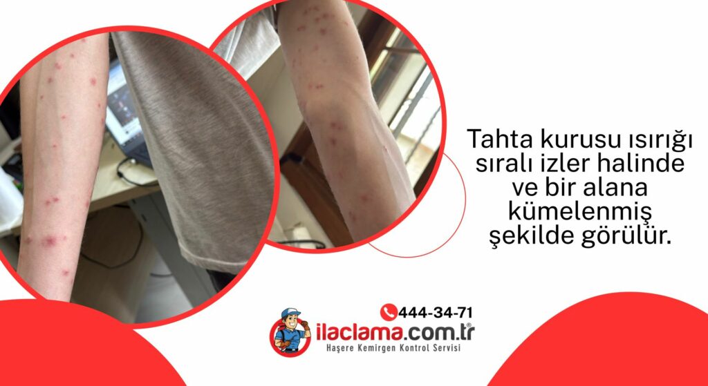 evde tahta kurusu ısırığının insan üzerindeki gerçek görüntüsü